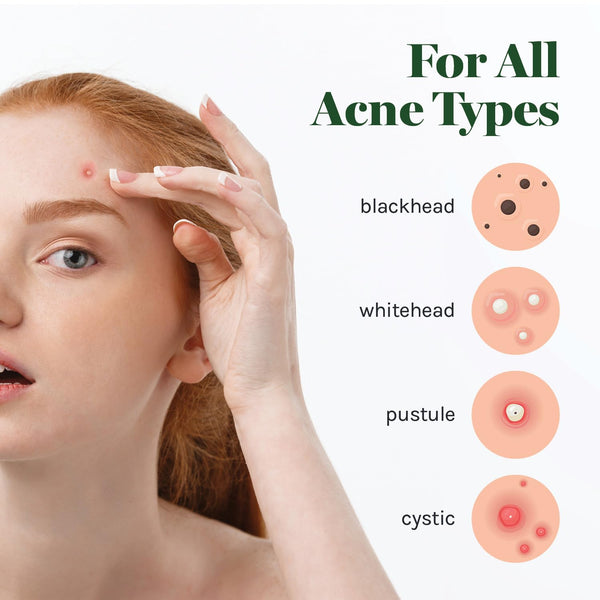 AOA Studio 84-count Hydrocolloid Acne Patches, Vegan, Cruelty-Free, 10mm, 12mm Sizes, Spot Treatment for Blemishes and Acne