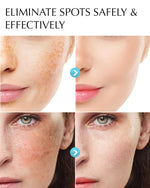 dark-spot-remover-for-face-and-body-hyperpigmentation-treatment-natural-ingredient-melasma-sun-spot-remover