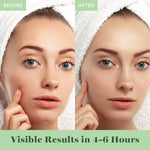 AOA Studio 84-count Hydrocolloid Acne Patches, Vegan, Cruelty-Free, 10mm, 12mm Sizes, Spot Treatment for Blemishes and Acne