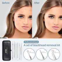jpnk blackhead remover tool comedones extractor acne removal kit for blemish whitehead popping 6 pc zit removing for nose face tools with leather bag