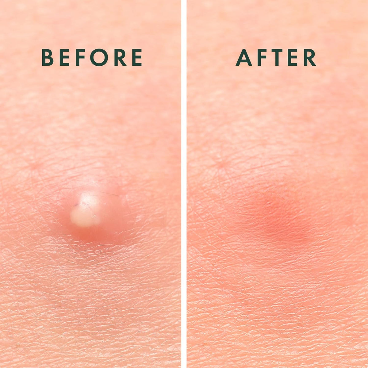 Rael Pimple Patches, Miracle Invisible Spot Cover - Hydrocolloid Acne ...