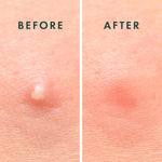 rael pimple patches, hydrocolloid acne spot cover, 2 sizes, korean skin care